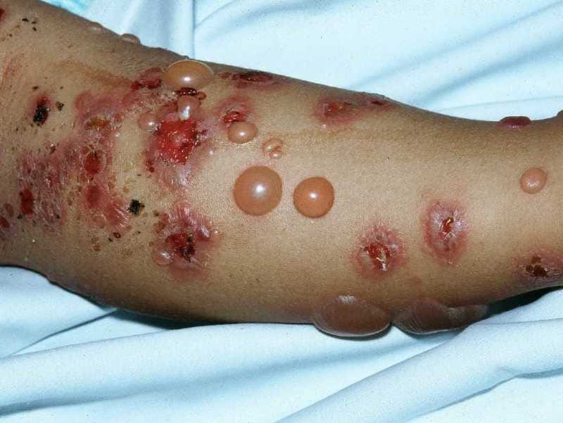 The WHO is still playing monkeypox down. Why?